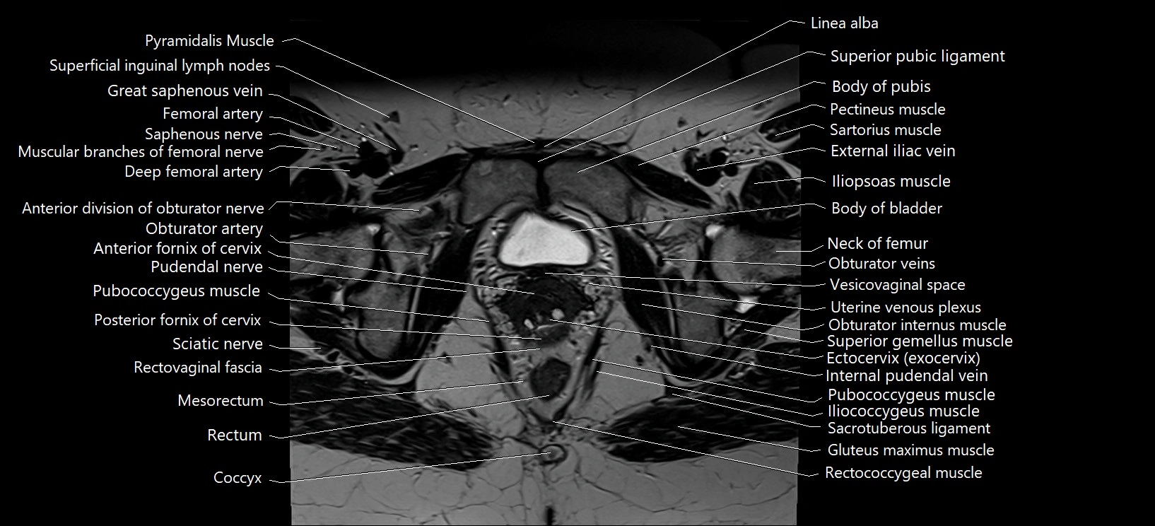 Axial cross sectional anatomy of female pelvis (MRI 3T) image 32.webp